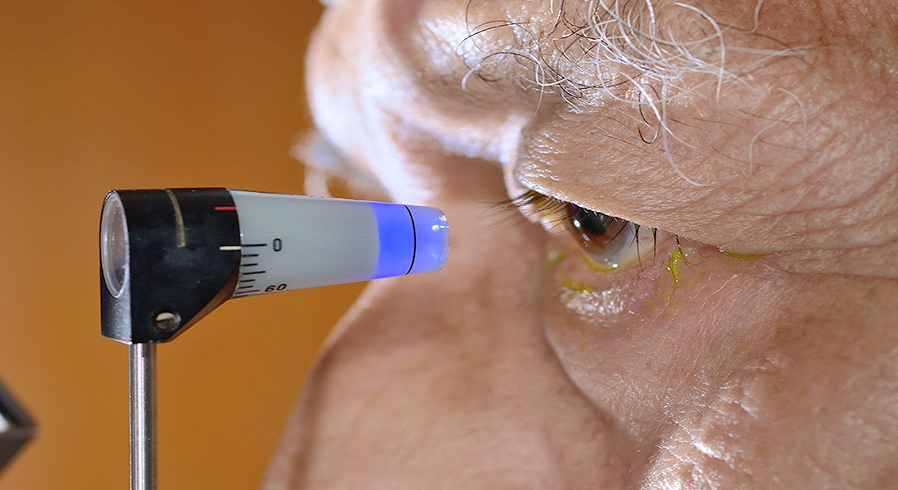 Hipertensión ocular4