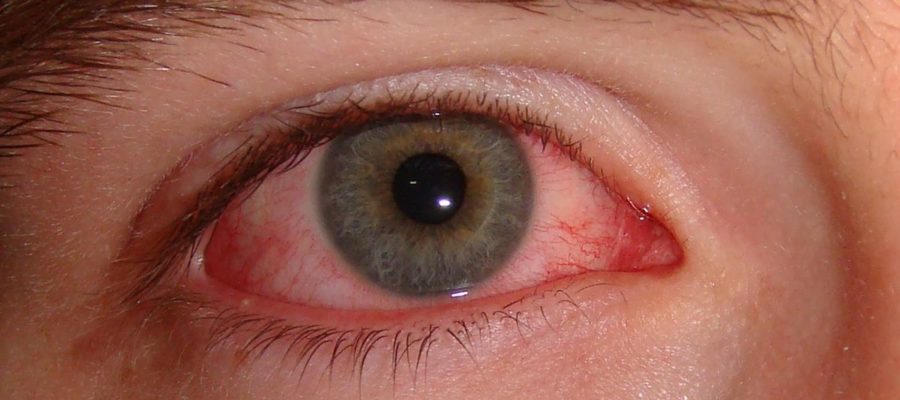 conjuntivitis conjuntivitis