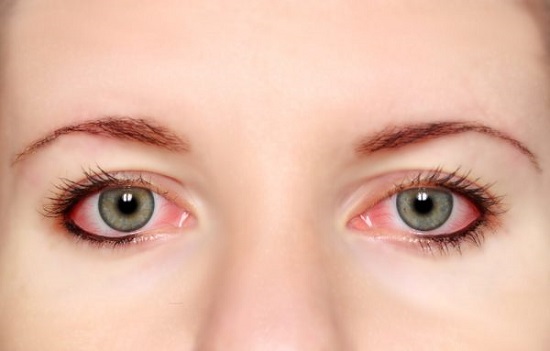 se produce conjuntivitis se produce conjuntivitis