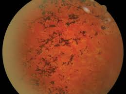Retinosis pigmentaria Retinosis pigmentaria