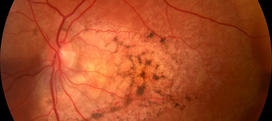 Tumores intraoculares Tumores intraoculares