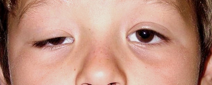 ptosis-c